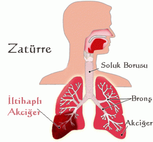 Zatürre Nasıl Olunur ?