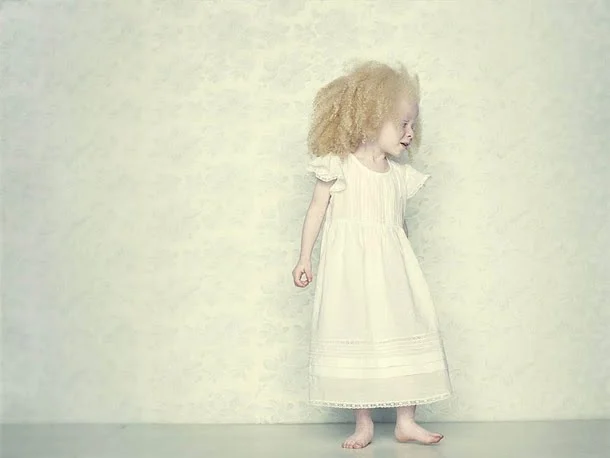 Albino Nedir ?